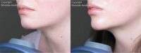 Juvederm Chin and Lip Enhancement