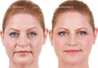 Juvederm for Lower Face and Lip Lines