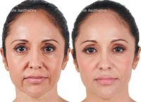 Juvederm for Lower Face