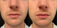 Man treated with Lip Augmentation