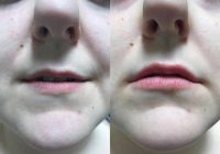 Woman treated with Lip Augmentation