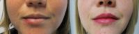 18-24 year old woman treated with Restylane