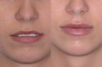 20 year old woman treated with Juvederm (Juvederm® Lips Fillers Enhancement)