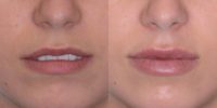 20 year old woman treated with Juvederm (lips volume increased) Juvederm® Lips Fillers
