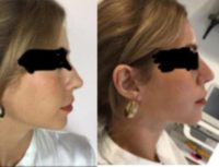 18-24 year old woman treated nonsurgical rhinoplasty