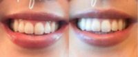 18-24 year old woman treated with Botox for Gummy Smile