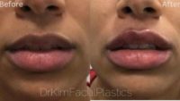 18-24 year old woman treated with Lip Fillers