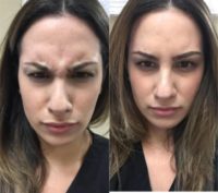 18-24 year old woman treated with Botox
