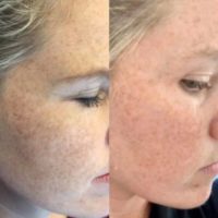 25-34 year old woman treated with VI Peel