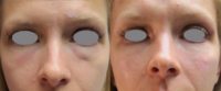 25-34 year old woman with dark circles treated with Restylane