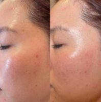 25-34 year old woman treated with HydraFacial