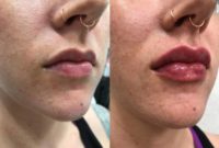 25-34 year old woman treated with Juvederm Ultra to Lips