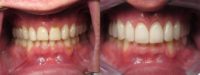 25-34 year old man treated with Porcelain Veneers
