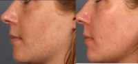 25-34 year old woman treated with Age Spots Treatment