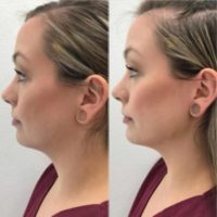 25-34 year old woman treated with Injectable Fillers to define her jawline