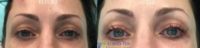 25-34 year old woman treated with Lash Lift