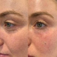 25-34 year old woman treated with Under Eye / Tear Trough Filler