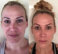 35-44 year old woman treated with Microneedling