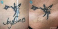 35-44 year old woman treated with Tattoo Removal