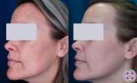 35-44 year old woman treated with Melasma Treatment