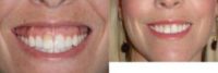 35-44 year old woman treated for Gummy Smile