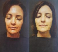 45-54 year old woman treated with Skin Rejuvenation