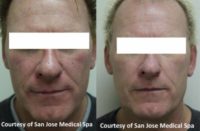 45-54 year old man treated with Rosacea Treatment (IPL)