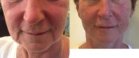 45-54 year old woman treated with Restylane on lips and Instalift on lower face