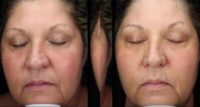 45-54 year old woman treated with Skin Rejuvenation