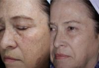 55-64 year old woman treated with Halo Laser and combo scition treatments.
