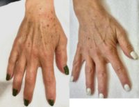 55-64 year old woman treated with IPL to hands