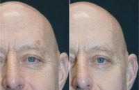 55-64 year old man treated with IPL for sun damage