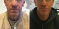 58 year old male treated with Sculptra