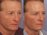 55-64 year old man treated with Botox