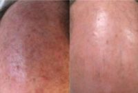 55-64 year old man treated with Fraxel Laser