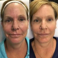 55-64 year old woman treated with Halo Laser