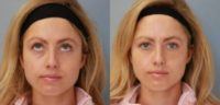 25-34 year old woman treated with Volbella for the Under Eyes