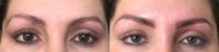 35-44 year old woman treated with Permanent Makeup
