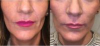 Woman treated with Restylane