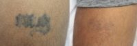 Amateur Tattoo Removed with PicoWay Laser