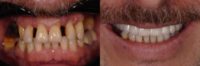 45-54 year old man treated with Dental Bridge, Dental Implants, Smile Makeover, Dental Bone Graft, Full Mouth Reconstruction