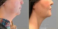 25-34 year old woman treated with AirSculpt