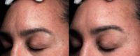 45-54 year old woman treated with Microdermabrasion