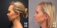 35-44 year old woman treated with Kybella