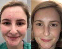 Woman treated with Skin Rejuvenation