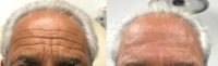 65-74 year old man treated with a combination of Botox and Filler