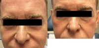 65 year old man treated with Halo Laser