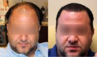35-44 year old male treated with FUE Hair Transplant