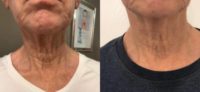 65-74 year old woman treated with ThermiSmooth Face