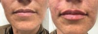 35-44 year old woman treated with Restylane Refyne for lip augmentation